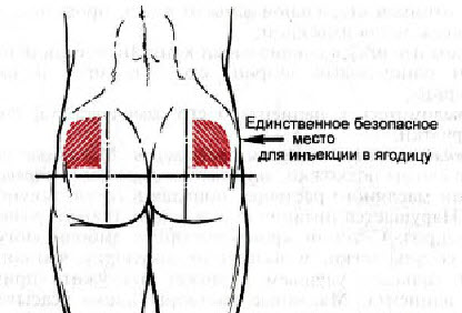 как самой сделать укол в ягодицу